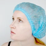 Rhinoplasty Turkey Cost What You Should Know